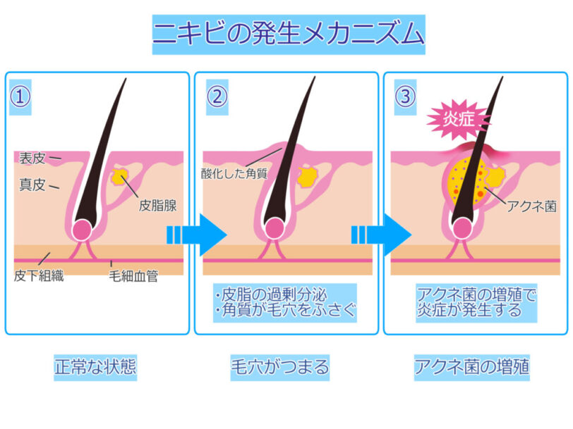 リファ　ニキビや肌荒れの原因