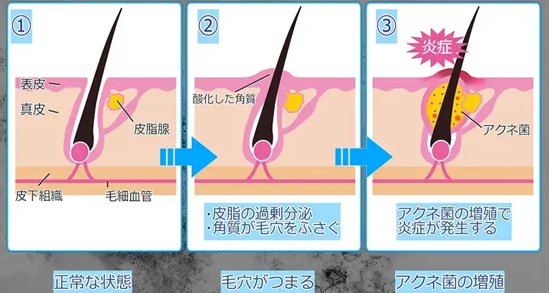 毛穴のつまりや、乾燥によるキメの乱れからくる毛穴の開き、またアクネ菌の繁殖が原因でできるニキビ。